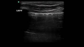 lung sliding absent