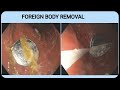 Foreign Body Removal #BD_ENDOSCOPY