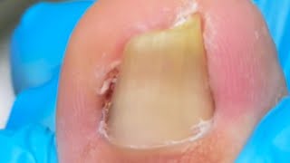 Stuff Cotton Under Large Ingrown Toenails To Avoid Further Injury【Crazy pedicure room】