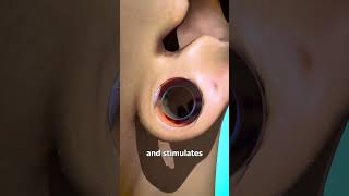 How Ear Gauges Can Tear Your Ears