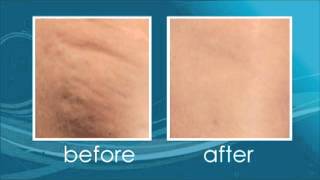 How Cellulaze treats Cellulite - a unique laser approach!