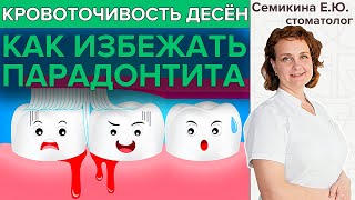 КРОВОТОЧИВОСТЬ ДЕСЁН| Как не допустить гингивита и парадонтита?