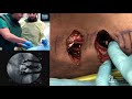 Far Lateral Corpectomy - Rod J. Oskouian, Jr, MD