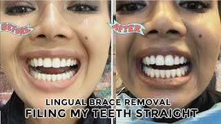 Filing round/chipped teeth straight (enameloplasty) \u0026 inbrace lingual braces removal day!