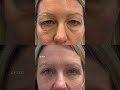 natural results with upper and lower eyelid surgery.