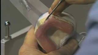 Construction of an Occlusal Bite Splint