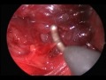 內視鏡甲狀腺手術之聲帶返喉神經 recurrent laryngeal nerve dissection under endoscopes