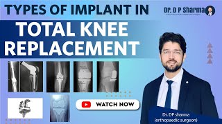 Types of Knee Replacement Implants| Which is the best in India - Dr DP Sharma