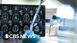 Managing Alzheimer's disease risk factors as potential new treatments emerge