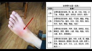 男子尿酸過高入院後痛苦難言，醫生檢查：竟是這3種食物惹的禍，還有很多人在吃