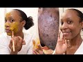 Say Bye bye to ACNE,PIMPLES(works 100%) using this turmeric honey mask