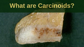 What are Carcinoid Tumours? - Pathology mini tutoriaL