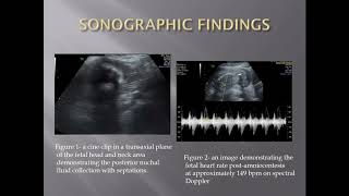 Turner Syndrome with Cystic Hygroma by Dani Wallace