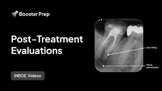 Endodontics | Post Treatment Evaluations | INBDE, NDEB, ADAT