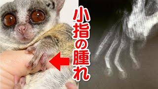 小指を怪我しました...【指の治療中】 Pizzatoru the Bushbaby / ショウガラゴのピザトル