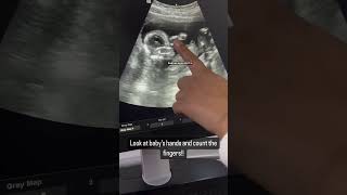 Baby hands POG 24 weeks on ultrasound #baby#pregnancy#shorts