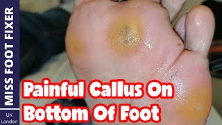 Painful Callus On Bottom of Foot full Treatment By Miss Foot Fixer