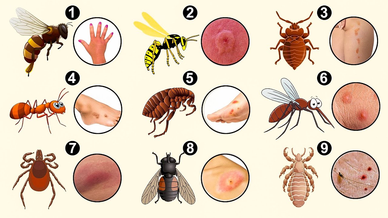 10 Bug Bites Anyone Should Be Able To Identify Bug Bi Vrogue Co 10 Bug Bites Anyone Should Be Able To Identify Bug Bi Vrogue Co