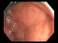 Colonoscopy Channel - Subtle lesion in the cecum