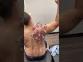 cupping therapy 😱 cupping cuppingtherapy viral shorts