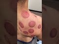 cupping therapy 😱 cupping cuppingtherapy viral shorts