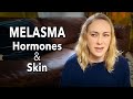 Hormones: Melasma & Your Skin