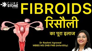 Uterine fibroids infertility कैसें करते हैं? Fibroids का treatment कैसें होता हैं?