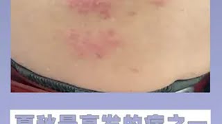 夏秋最高发的病之一 四步教你处理带状疱疹 蛇缠腰 缠腰龙 急救 健康科普