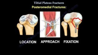 Tibial Plateau Fractures - Everything You Need To Know - Dr. Nabil Ebraheim