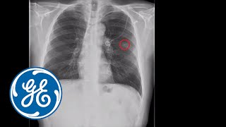 GE Healthcare X-ray:GE Healthcare's VolumeRAD: Lung Nodule Detection | GE Healthcare