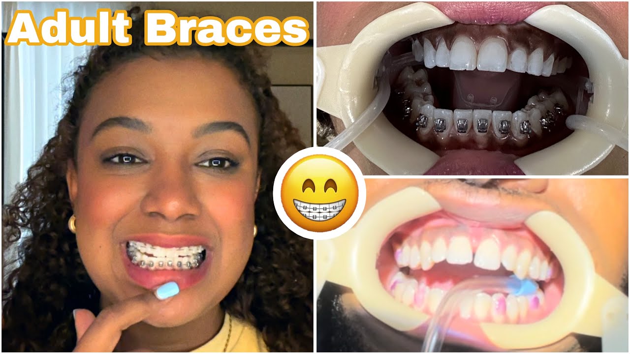 Getting Braces Again Youtube