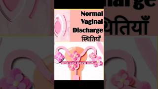 Vaginal Discharge की सामान्य स्थितियाँ#Leucorrhoea