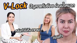 V Lock แก้ปัญหาแก้มย้อย ร่องน้ำหมาก หลังทำไม่ถึง 24ชม. มาคุยกัน