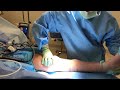 knee motion after arthroscopic arthrofibrosis removal