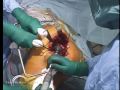 birmingham hip resurfacing bhr surgery by derek mcminn part 2