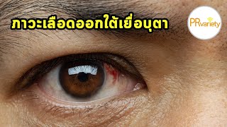 ภาวะเลือดออกใต้เยื่อบุตา (Subconjunctival Hemorrhage)