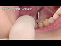 【dental】super rigid zirconia crown by japanese super technician 適合の良いジルコニアクラウンは歯科技工士の手によって調整される。