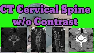 CT Cervical Spine without Contrast