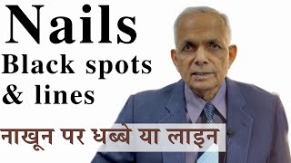 Nails black lines and black spots : नाखूनों पर काली लाइन या धब्बे #blacknails #nails