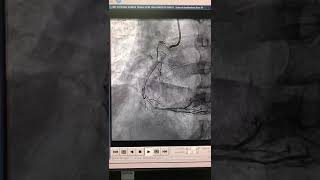 Successful Opening and stenting of old 100 % blocked right coronary artery again by wrist