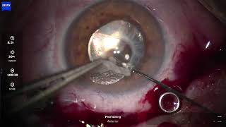 persistent macular holes and amniotic membranes with subretinal strecthing