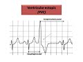 ECG course: Ectopics in ECG, Dr. Sherif Altoukhy