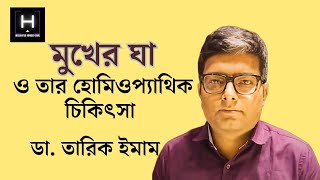 মুখের ঘা ও তার হোমিওপ্যাথিক চিকিৎসা | Homoeopathic Treatment Of Stomatitis |  ডা. তারিক ইমাম |