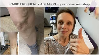 Vein Ablation / My Varicose Vein Story / Before and After