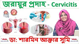 জরায়ুর প্রদাহ - Cervicitis - সার্ভিসাইটিস - Homeopathic Doctor Bangladesh - ডা: শারমিন আক্তার সুমি