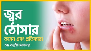 জ্বর ঠোসার কারন এবং প্রতিকার। Causes and treatment of Aphthous Ulcer.