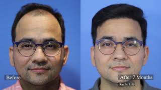 Growing hair in Singapore - Naresh's awesome transformation