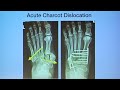 charcot midfoot and ankle technique tips