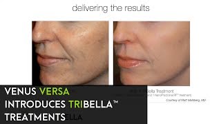 TriBella™ Treatments by Venus Versa™