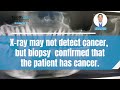 can oral cancer be diagnosed through an x ray dr. v explains